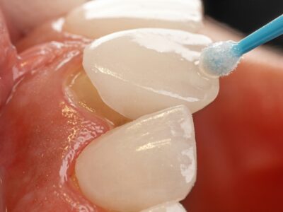 Close-up of a treatment gel being applied to a front tooth with a fine applicator brush