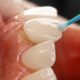 Close-up of a treatment gel being applied to a front tooth with a fine applicator brush
