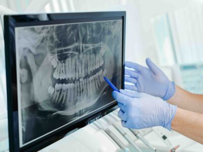 Dentist pointing to a lower molar on a panoramic dental x-ray while planning a tooth extraction