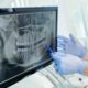 Dentist pointing to a lower molar on a panoramic dental x-ray while planning a tooth extraction